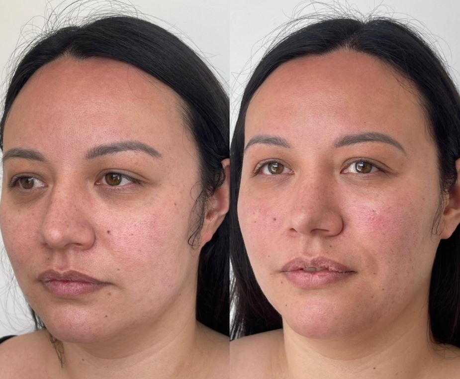 Jessica Ward before & after treatment.